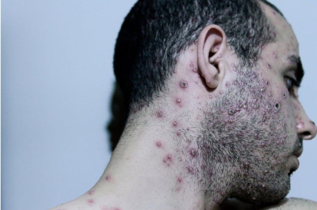 Kenya: seven experiences of experienced mpox